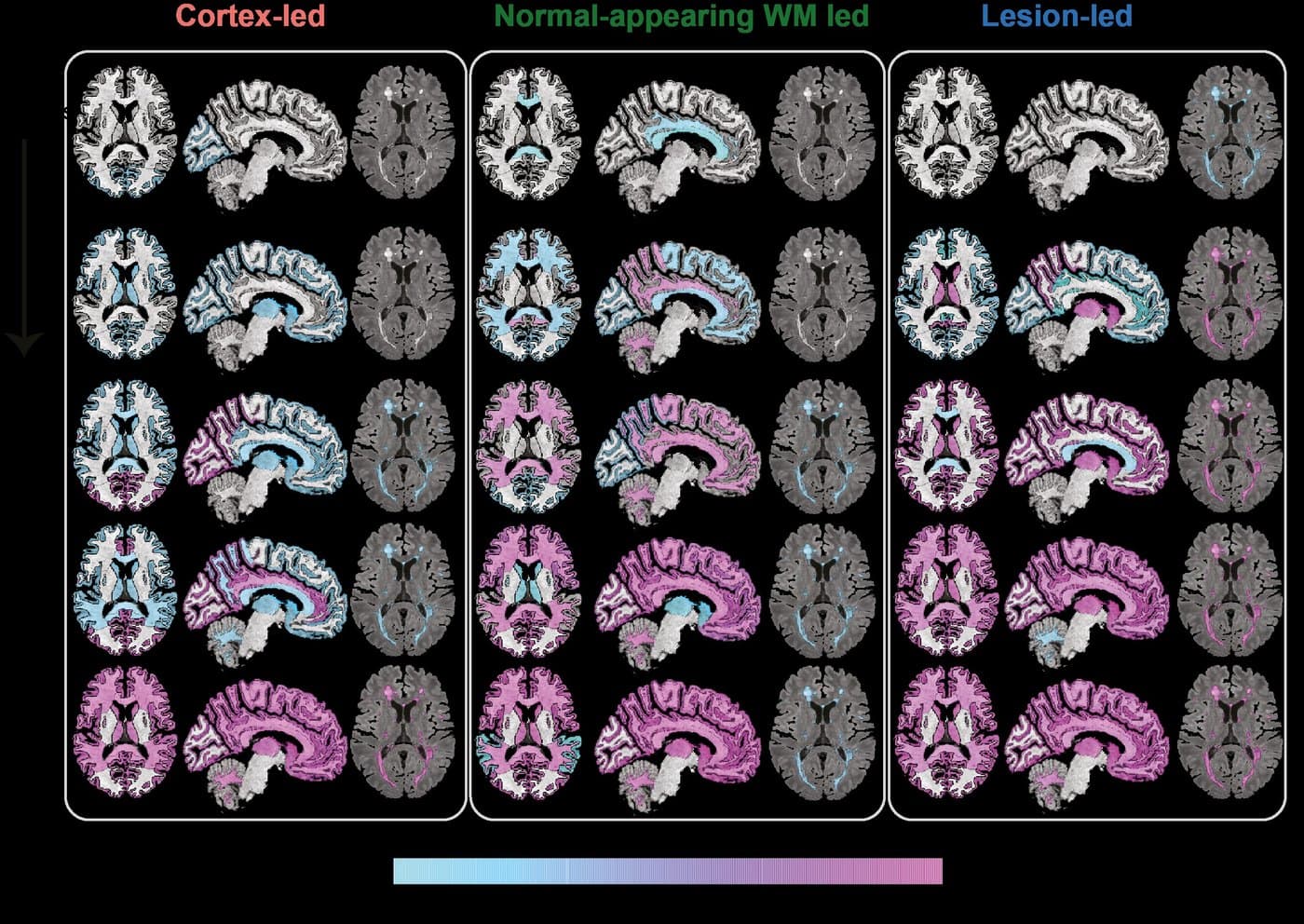 Brain maps for three MS subtypes, cortex-led, normal-appearing white matter-led and lesion-led, each shown over five stages