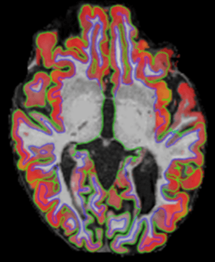 Axial MRI slice with grey- and white-matter segmentation outlines